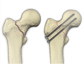 Медиальные переломы бедра