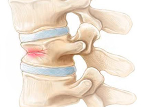 Компрессионный перелом тела позвонка